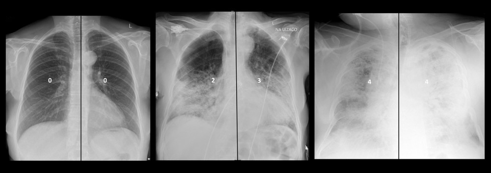 Chest X-ray images of 3 COVID-19-positive patients with different intensity of lung involvement assessed with RALE classification. In the left picture both lungs present no involvement and the overall score was assessed as 0; in the middle picture the right lung involvement is assessed as 25–50% and the left lung as 50–75%, the overall RALE score was assessed as 5; in the right image lungs are involved in nearly 100%, the overall RALE score was assessed as 8.