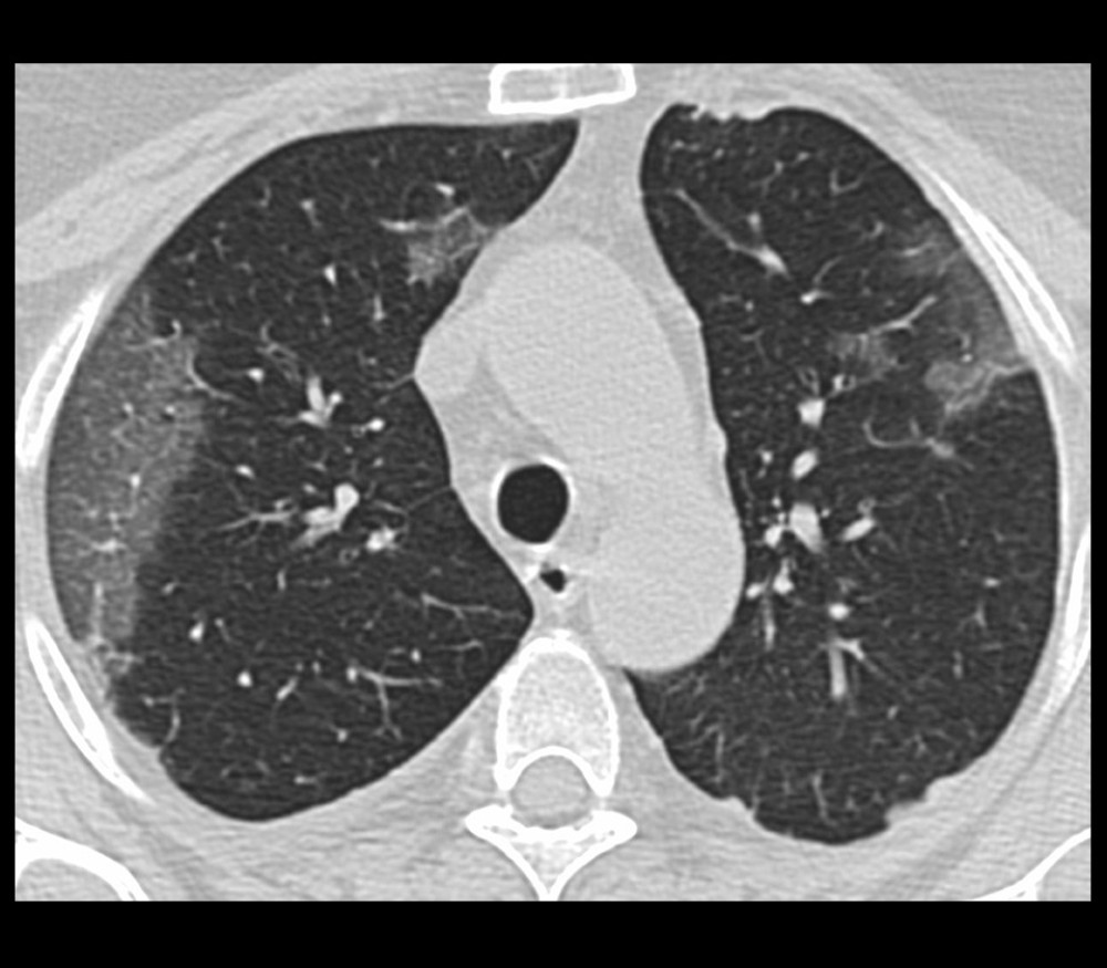 Non-contrast chest CT image of a 20-year-old man with mild COVID-19 pneumonia in the axial plane. CT scan shows ground-glass opacities in multiple lung segments.