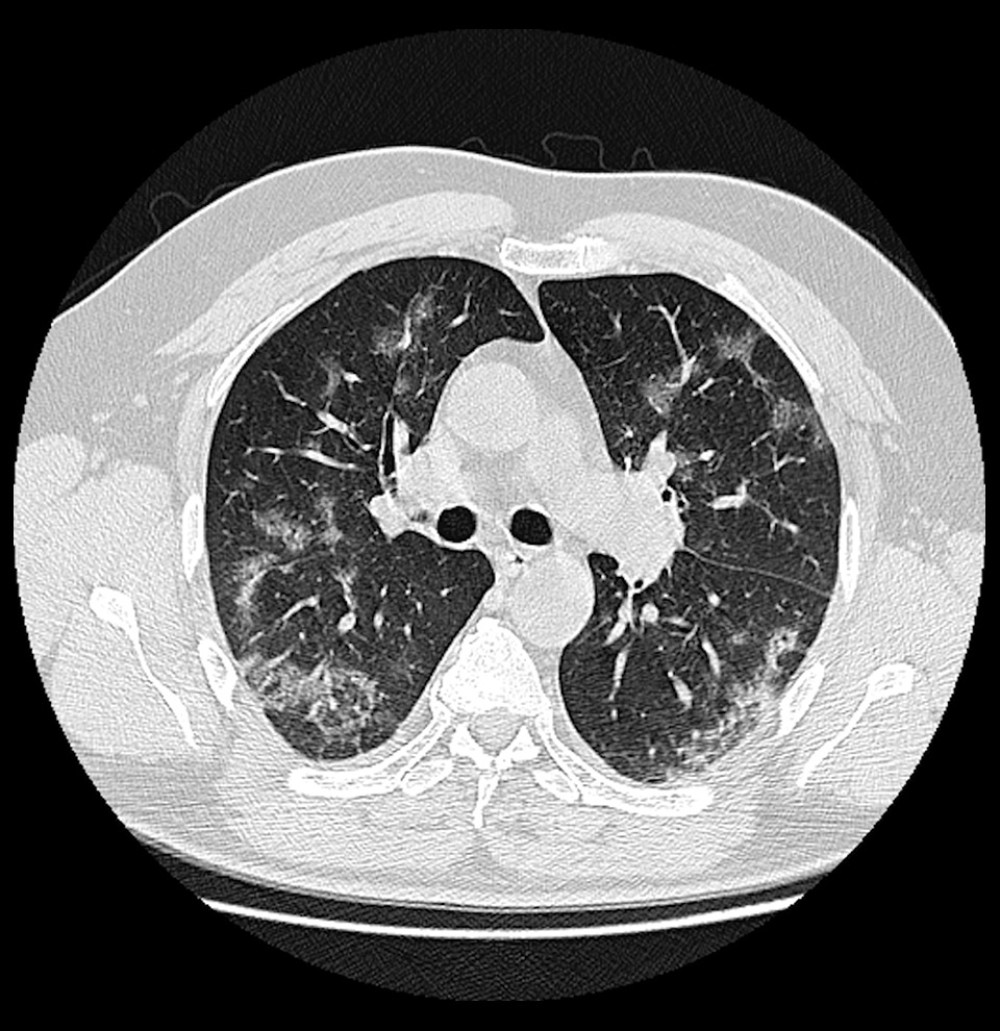 A 66-year-old male COVID-19 patient presenting cough and myalgia for 7 days. CT scan shows a reticular pattern superimposed on the background of GGO, resembling the sign of crazy paving stones.