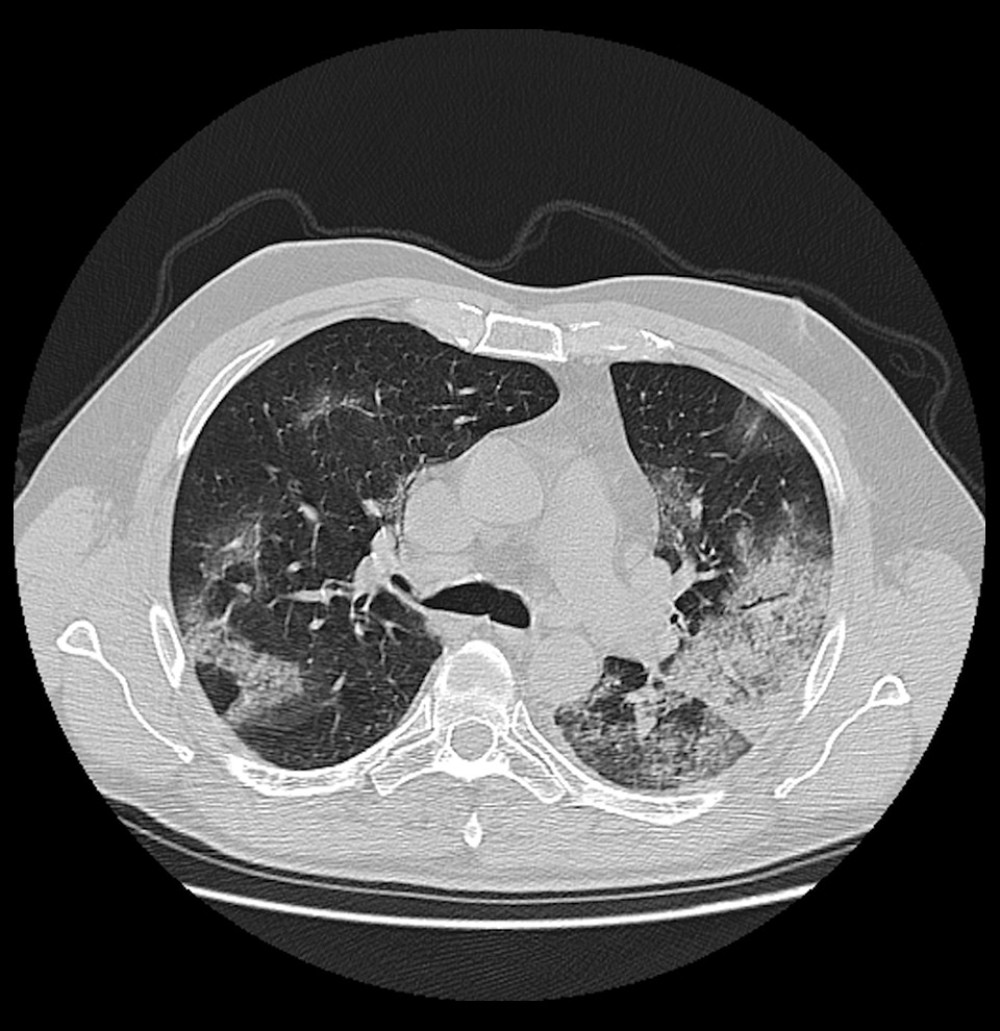 A 82-year-old male COVID-19 patient presenting fever with cough for 11 days. CT scan shows bilateral pulmonary consolidations.