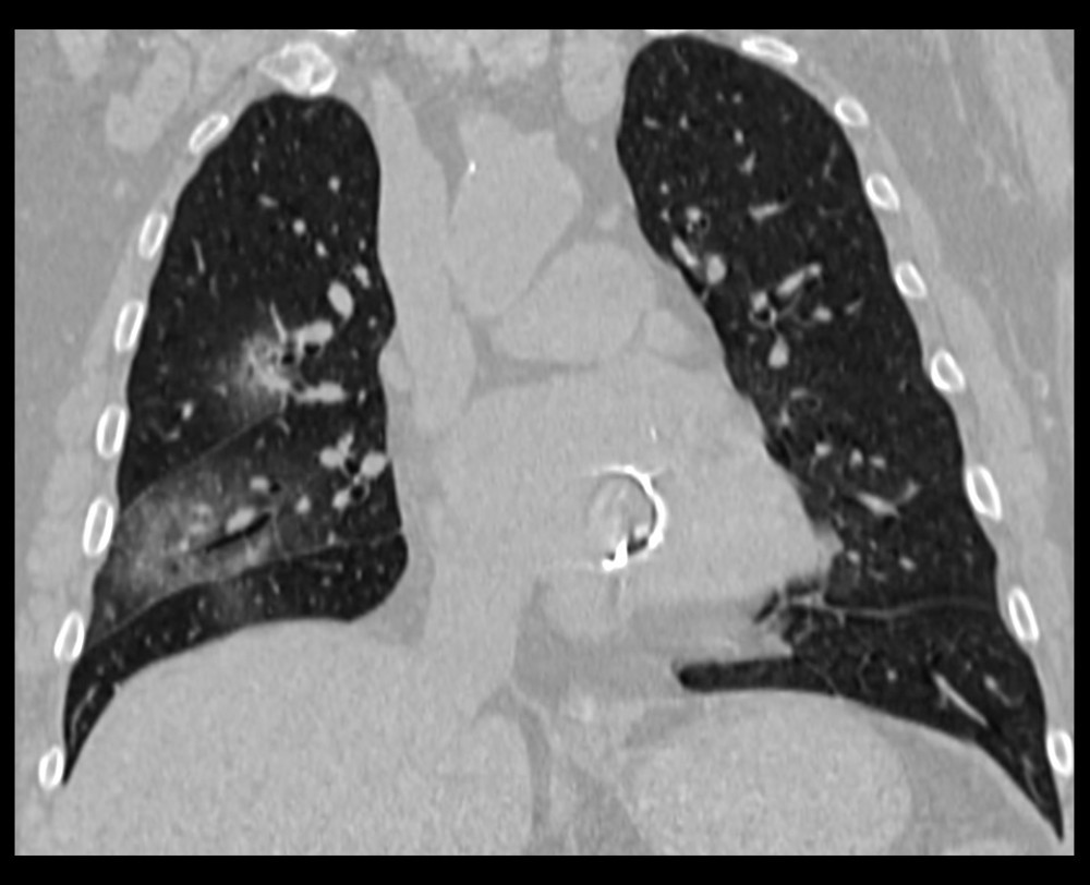 Non-contrast chest CT image of a 27-year-old man with mild COVID-19 pneumonia in the coronal plane. CT scan shows traction bronchiectasis in the right upper and middle lobe.