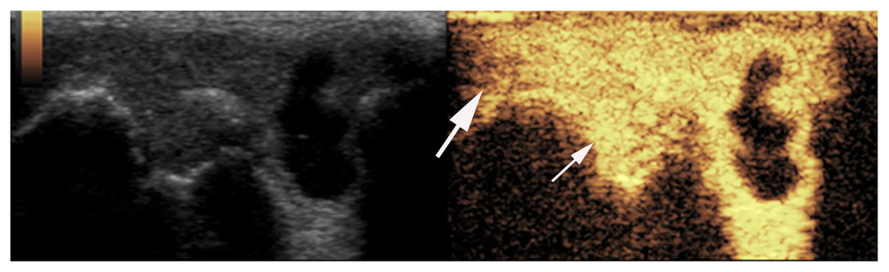 Synovial ultrasound contrast. Synovial enhancement (small arrow) was significantly greater than the surrounding tissue (large arrow).