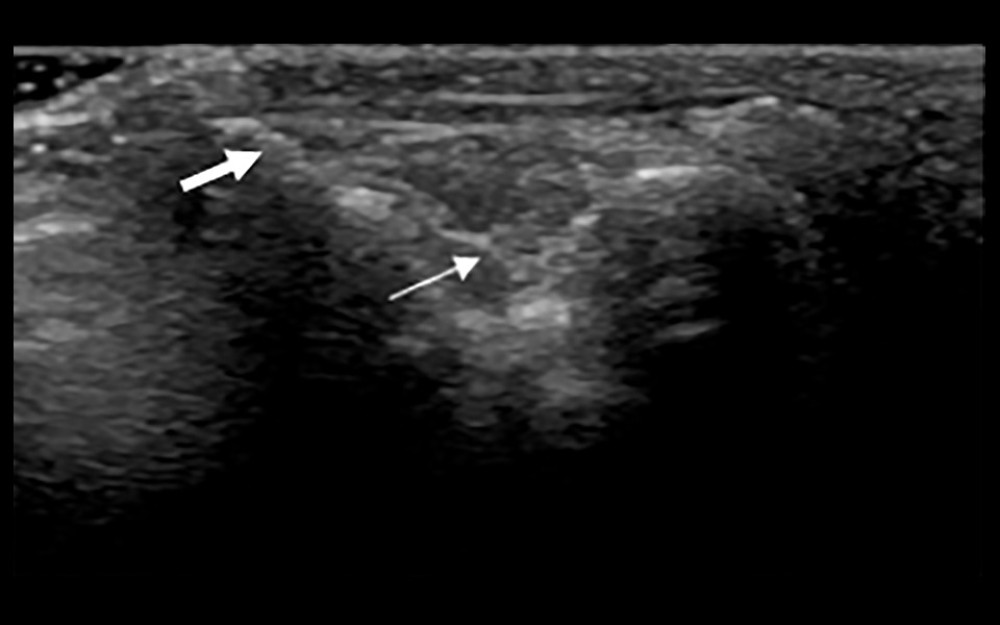 Synovial membrane grade 2 thickening. Thickening of the synovial tissue reached the joint head (small arrow), but did not reach the diaphysis (big arrow).