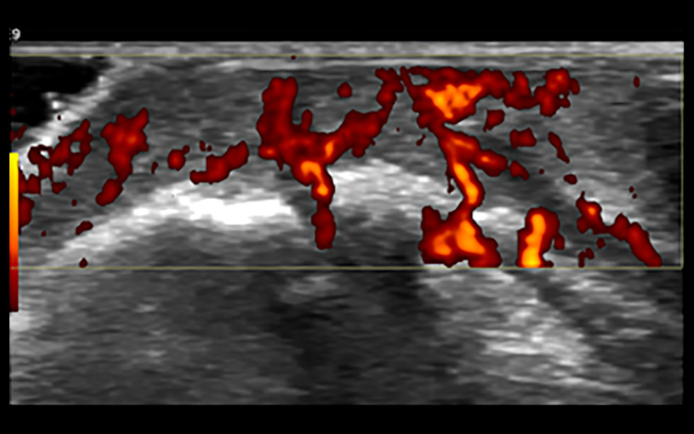 Synovial grade 3 blood flow signal. Blood flow was detected through the synovium.