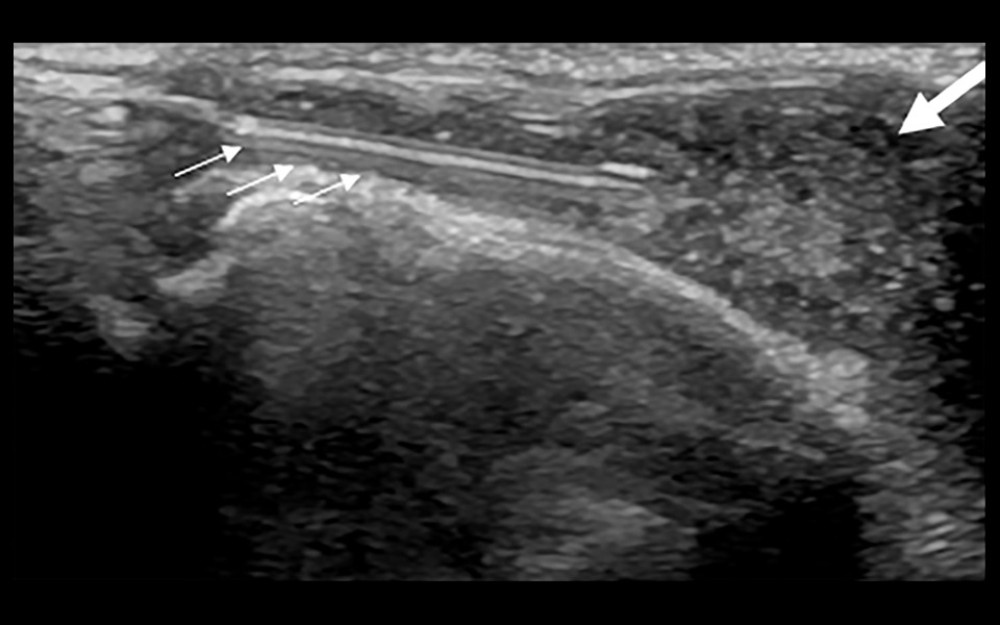 Ultrasound-guided synovial puncture. 18-G puncture needle (small arrows) accurately entered the synovial tissue (large arrow).