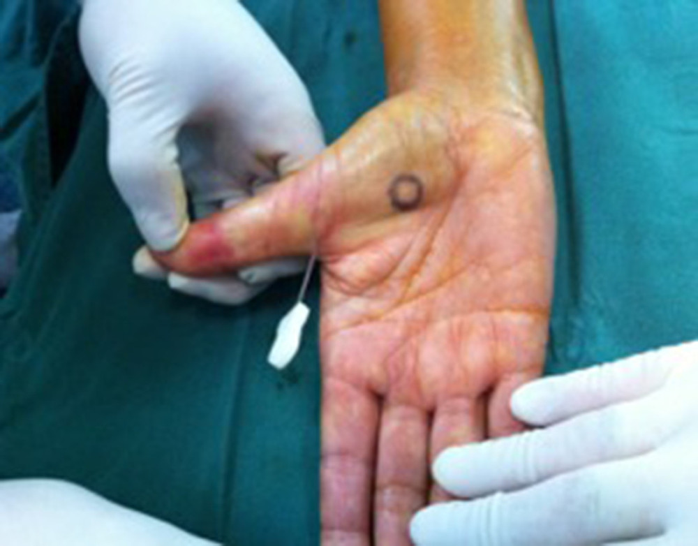 The site used for the needle to treat trigger digit in patients.