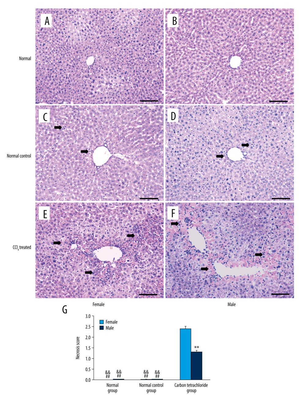Detection of liver damage in mice by hematoxylin-eosin staining (H&E staining) at 24 h after intraperitoneal injection of CCl4. (A–F) Liver damage of the female normal group, the male normal group, the female normal control group, the male normal control group, the female CCl4 group, and the male CCl4 group, respectively. (G) Area of necrosis. Measurements of liver sections of at least 10 mm2 per mouse were performed using ImagePro Plus 6.0 software. ** P<0.01: there was a significant difference between the female group and the male group. ## P<0.01: there was a significant difference between the female CCl4 group and the normal group or the normal control group. && P<0.01: there was a significant difference between the male CCl4 group and the normal group or the normal control group. Experiments were repeated in triplicate (scale bar, 50 μm). H&E – hematoxylin and eosin.