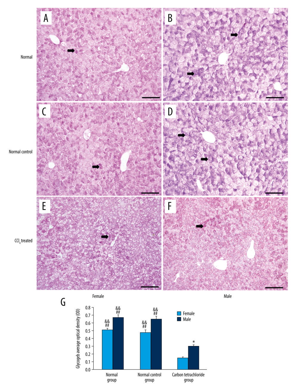 Detection of glycogen expression by periodic acid Schiff reagent staining (PAS staining) assay of staining at 24 h after intraperitoneal injection of CCl4. (A–F) Liver PAS staining of the female normal group, the male normal group, the female normal control group, the male normal control group, the female CCl4 group, and the male CCl4 group, respectively. (G) Uniform white balance processing, two-color segmentation, and optical density analysis using Motic Images Advanced 3.2 software. At least 12 mm2 of liver tissue sections were tested for each mouse. ** P<0.05: there was a significant difference between the female group and the male group. ## P<0.01: there was a significant difference between the female CCl4 group and the normal group or the normal control group. && P<0.01: there was a significant difference between the male CCl4 group and the normal group or the normal control group. Experiments were repeated in triplicate (scale bar, 50 μm). PAS – periodic acid-Schiff.