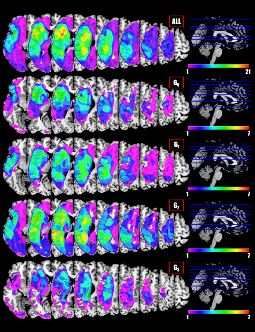 Lesion maps for the 27 included stroke patients. Each voxel value is the number of participants whose stroke lesion extends to that particular voxel (all pictures in neurological convention – left in the figure corresponds to left in the brain). Top lesion map depicts all participants together, then divided by groups.