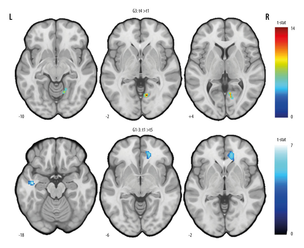 FMRI semantic decision/tone decision (SDTD) task result (general linear model). Paired t tests were computed between time-points for each iTBS group (contrast SD >TD). For every contrast, corrected data are provided (Cluster-wise FDR, P<0.05) with peak coordinates in Table 3. All pictures are in neurological convention (left in the figure corresponds to left in the brain).