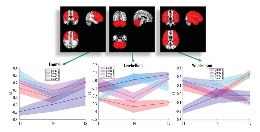 Results of Laterality Index (LI) analyses. Results are depicted for frontal mask (left), cerebellum mask (center), and whole-brain mask (right). Paired t tests revealed a significant increase between t1 and t4 for G3 (3 weeks of iTBS, P=0.02) with cerebellum mask, and a significant increase between t4 and t5 for G0 (P=0.04) with whole-brain mask.
