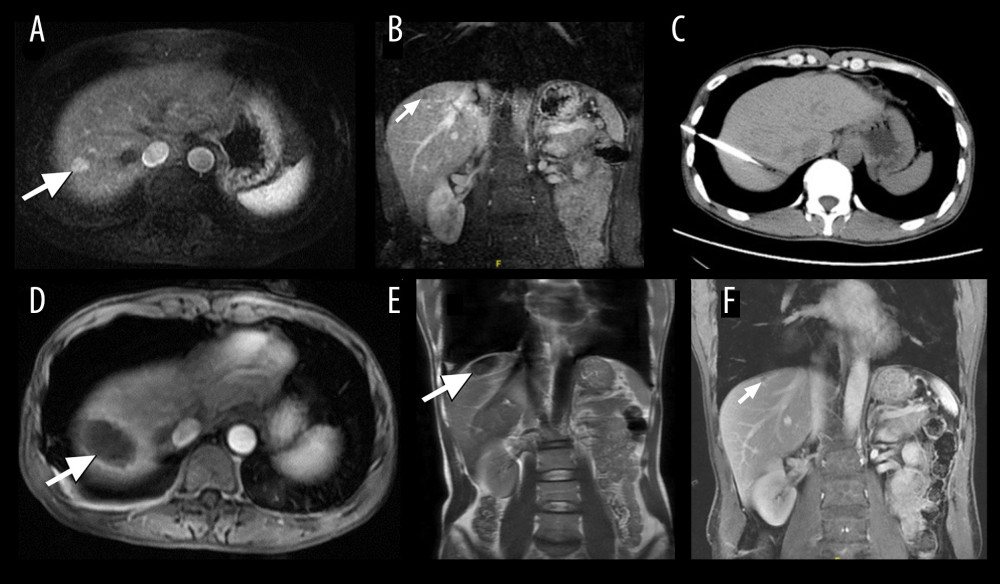 A 45-year-old man who underwent cryoablation for small hepatocellular carcinoma (HCC). (A, B) Axial and coronal magnetic resonance imaging (MRI) obtained during the arterial phase shows a nodule of approximately 1.1×1.5 cm (white arrow), located in liver segment VIII, abutting the diaphragm. (C) Cryoprobes were inserted into the tumor under computed tomography guidance. (D, E) MRI scanning 4 days after cryoablation of HCC. The HCC lesion was completely ablated, showing a hypovascular zone with a hypervascular inflammatory rim around the ablation zone (white arrow). (F) MRI scanning at 12 months after treatment shows that the ablated area had shrunk significantly (white arrow).