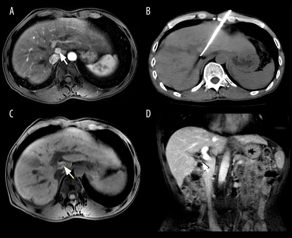 Images from a 51-year-old man who underwent cryoablation for small hepatocellular carcinoma (HCC) located in liver segment I. (A) Magnetic resonance imaging (MRI) axial scan in the arterial phase before cryoablation; 1 nodule located in liver segment I (white arrow). (B) Cryoprobes were inserted into the tumor under CT guidance. (C) MRI scan preformed 3 days after cryoablation indicated technical success. (D) MRI scanning shows that local tumor recurrence (white arrow) was not found at the 18-month follow-up.