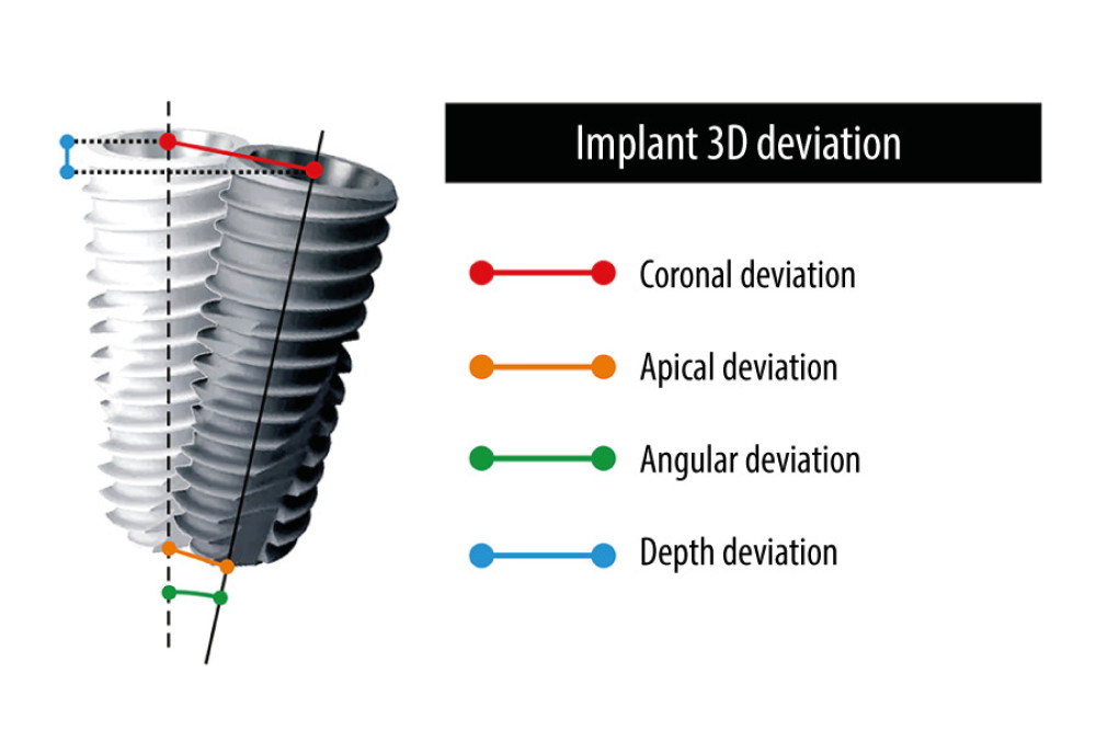 The accuracy evaluation analyzed by the implant 3-dimensional deviation between the designed and the actual implant position including coronal deviation, apical deviation, angular deviation, and depth deviation from the axis.