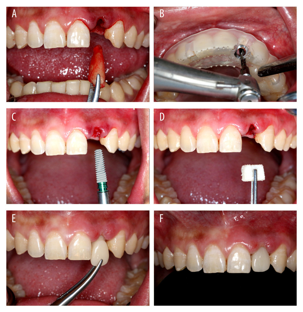 Immediate implant placement and immediate restoration. (A) Minimally invasive extraction without flaps. (B) Three-dimensional guide-assisted preparation of holes. (C) Implantation. (D) Implantation of collagen. (E) Insertion of temporary restorations. (F) Immediate restoration completed.