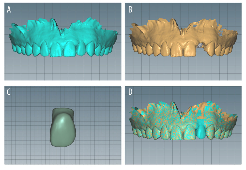 Obtaining the digital impression. (A) Intraoral scanning of the soft and hard tissues and the temporary crown. (B) Intraoral scanning of the implant position. (C) Extraoral scanning of the supragingival and subgingival shapes of the temporary restoration. (D) Generation of the soft tissue cuff shape based on the subgingival morphology of the temporary restoration