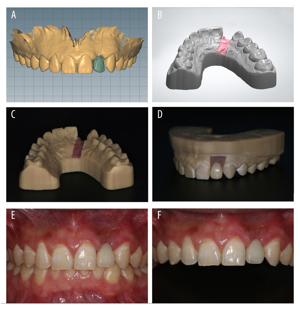 Final restoration. (A) Design of the inner crowns of restoration. (B) Digital impression of the model. (C) Three-dimensional printing of the manufactured model. (D) Final restoration on the model. (E) Front view of the intraoral image at the occlusal position. (F) Front view of the intraoral image at the occlusal position with a black background.