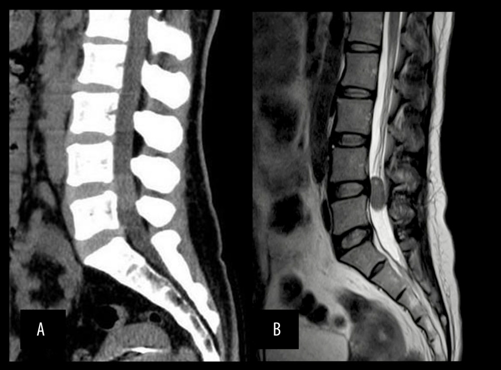 (A) Computed tomography image of the lumbar spine showing a normal vertebral sequence and no calcification in the spinal mass; (B) lumbar magnetic resonance imaging showing an oval mass in the spinal canal.