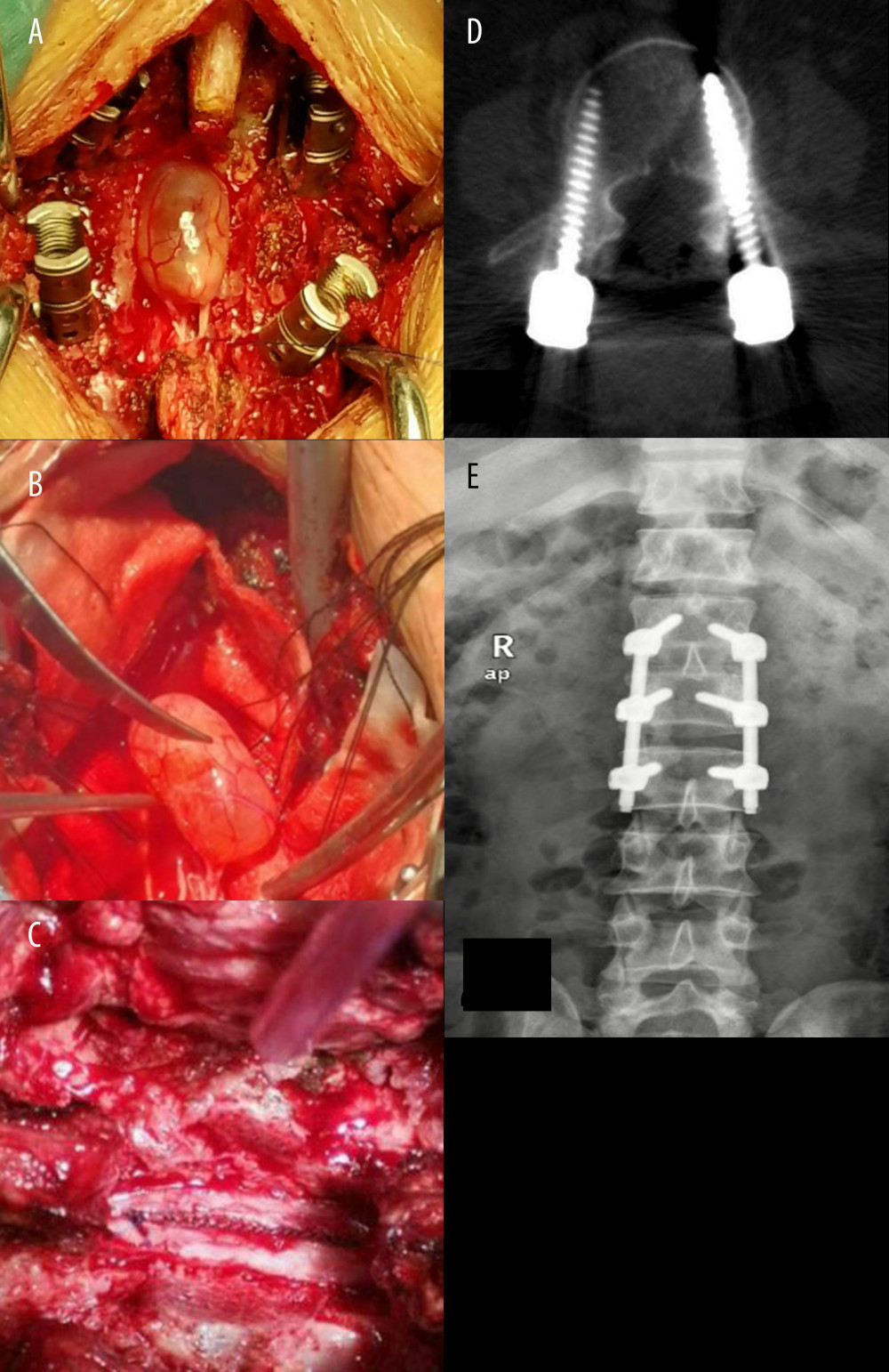 (A) The exposure of the dural sac after total laminectomy; (B) tumor tissue connects with nerve root; (C) the dural sac incision with continuous suture; (D, E) postoperative images of the patient.