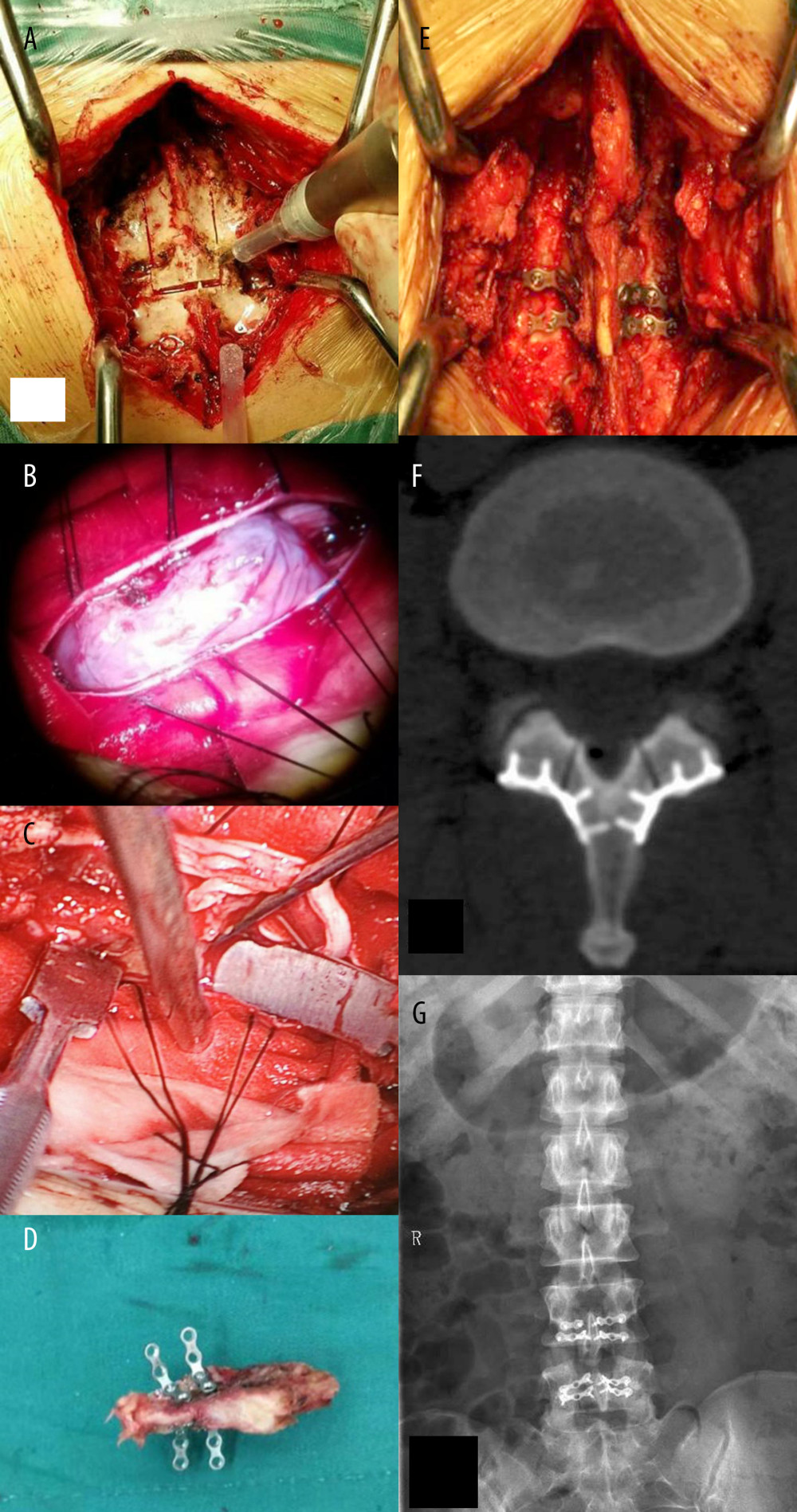 (A) Laminectomy under ultrasonic osteotome; (B) the tumor tissue under a microscope; (C) intraoperative image of the microscope screen; (D) the free lamina with a titanium plate; (E) replantation of lamina and spinous process in the original location; (F, G) postoperative images of the patient.