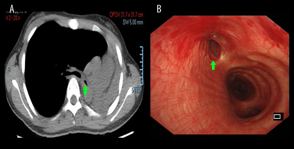 Chest HRCT and bronchoscopy features of patients with PTBMChest HRCT showing left main bronchus stenosis lesion (A, green arrow) due to TBTB. Diagnostic bronchoscopic appearance of PTBM (B, green arrow) can be observed in the left main bronchus. HRCT – high-resolution computed tomography; PTBM – post-tuberculosis bronchomalacia; TBTB – tracheobronchial tuberculosis.