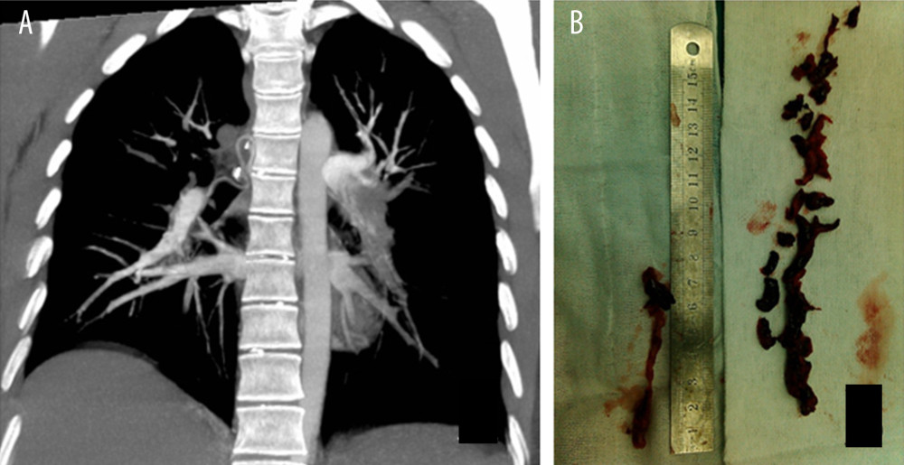 Pre- and postoperative images relating to case 4, who suffered sudden cardiac arrest. (A) Computed tomography angiogram showing the left pulmonary artery trunk to be completely blocked by the embolism. (B) Photograph of the surgically removed embolism.