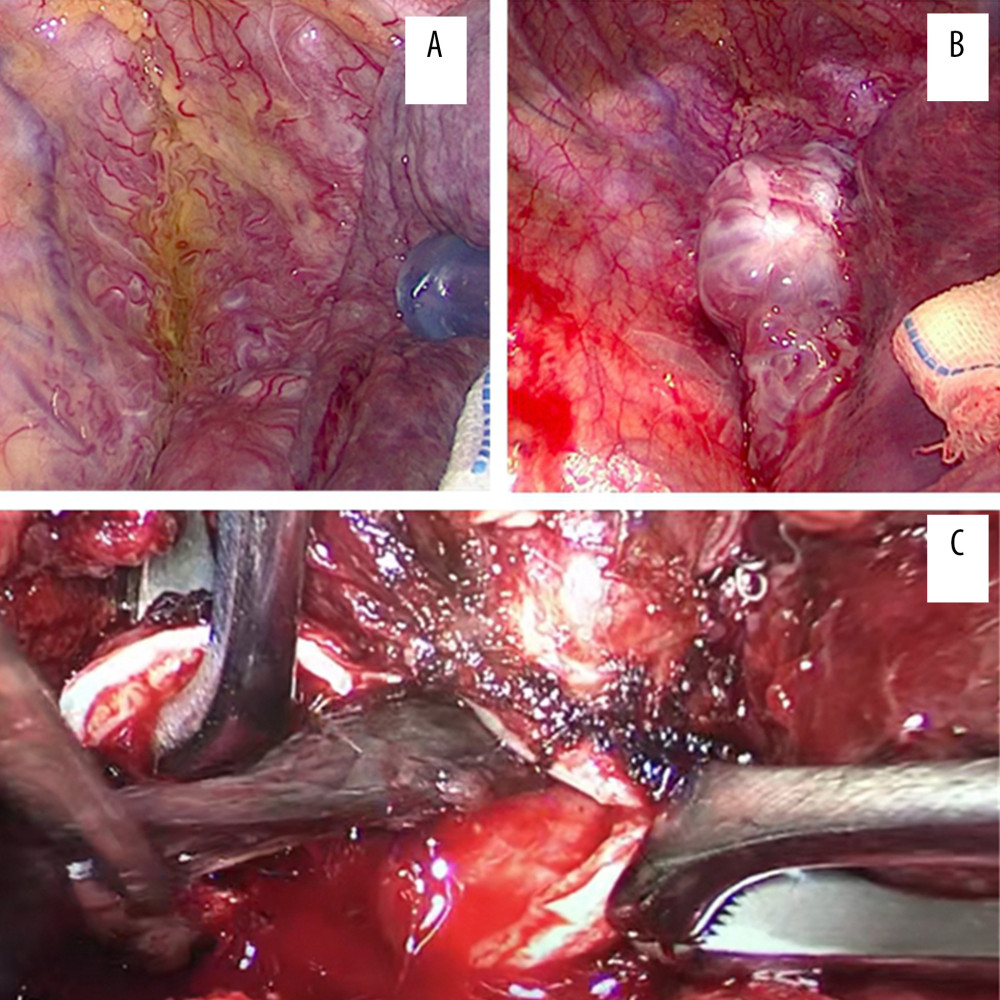Supported by VV-ECMO, the surgery was performed independent of intubation and ventilation. (A) Massive abnormal vascular hyperplasia in the right upper mediastinum. The normal mediastinum pleura was not visualized. (B) The hemangioma was composed of a large number of crisscrossed arteriovenous masses. (C) Intraoperatively, the right intermediate bronchus was opened. Several blood clots can be seen blocking the bronchus. The blood clots in the main airway were completely removed.