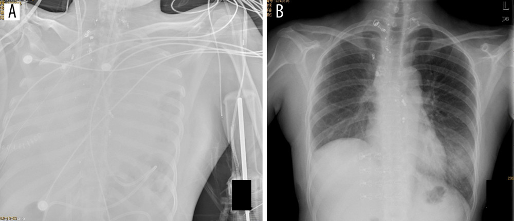 Pre- and postoperative X-ray images from case 13 admitted for repeated hemoptysis. (A) Preoperative X-ray revealed complete whiteout of the lungs due to bleeding from a branch of the right bronchus. (B) Postoperative X-ray prior to discharge shows resolution of whiteout.