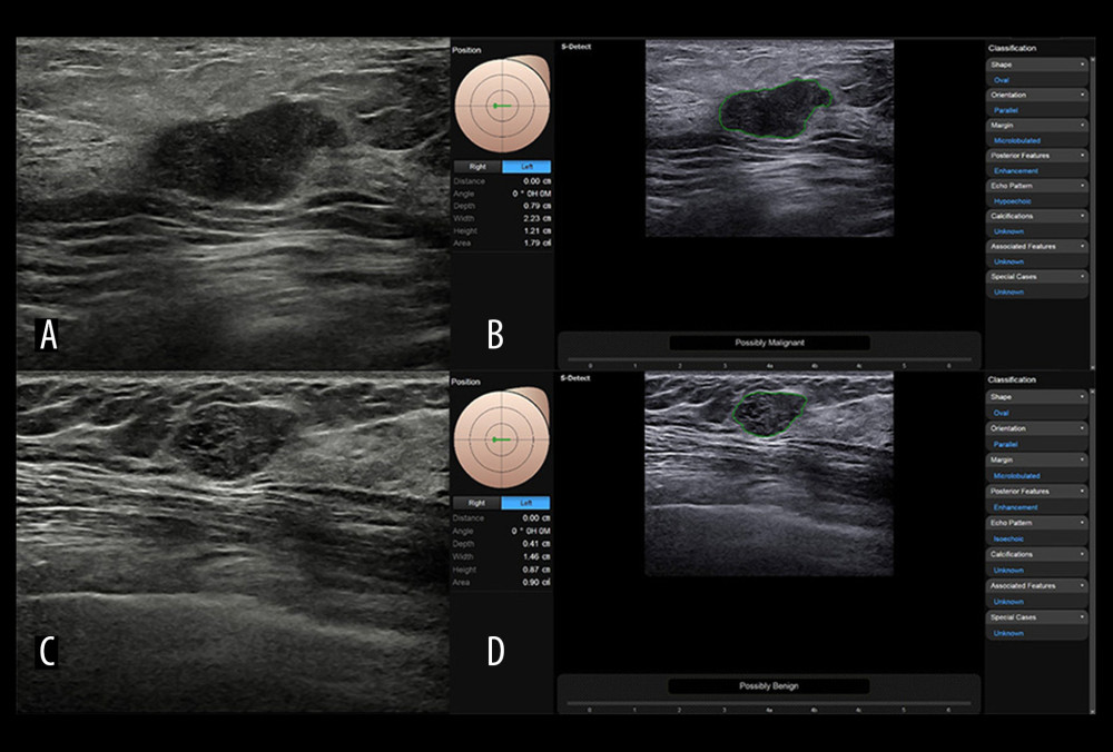 Representative case of (A, B) malignant and (C, D) benign breast nodulesImages of (A) B-mode US and (B) S-Detect result of a 67-year-old woman with invasive cancer in her right breast. After the region of interest was set, S-Detect automatically analyzed the ultrasound features of the lesion and displayed a final assessment of “possibly malignant” based on the lesion features listed in the right column: oval shape, parallel orientation, microlobulated margin, hypoechoic echo pattern, and posterior features enhancement. Images of (C) B-mode US and (D) S-Detect result of a 47-year-old woman with fibroadenoma in her right breast. After the region of interest was set, S-Detect automatically analyzed the ultrasound features of the lesion and displayed a final assessment of “possibly benign” based on the lesion features listed in the right column: oval shape, parallel orientation, microlobulated margin, isoechoic echo pattern, and posterior features enhancement.
