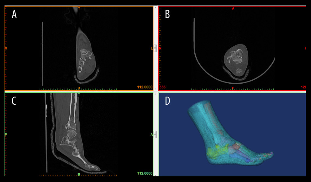 3D foot reconstructionThe participants were in the supine position while standing still, and the computer tomography (CT) scan of 64-channel spiral was obtained in the sequential mode. Images were obtained and imported into medical image processing software Mimics 17.0 for 3D reconstruction. (A) coronal CT image; (B) transverse CT image; (C) sagittal CT image; and (D) foot reconstruction.