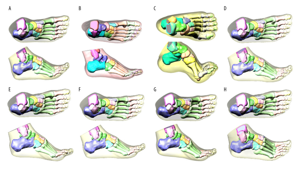 3D finite element model of healthy foot, flatfoot, clubfoot, and foot with Lisfranc joint injuryA 3D solid model of foot bone was constructed by SolidWorks 2017 software, and the cartilage layer with a thickness of 1–2 mm was established on bone joint to obtain finite element model. (A) Healthy foot; (B) flatfoot; (C) clubfoot; (D) the first metatarsal fracture; (E) the second to fourth metatarsal dislocation; (F) the second to fifth metatarsal dislocation; (G) the second metatarsal fracture combined with the third to fifth metatarsal dislocation; and (H) the medial cuneiform fracture combined with second and third metatarsal dislocation.