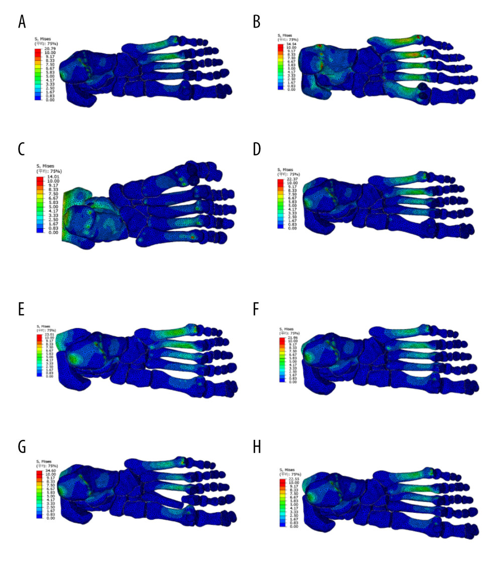 Distribution of von Mises stress in healthy foot, flatfoot, clubfoot, and foot with Lisfranc joint injuryABAQUS software was used to analyze the von Mises stress distribution of the finite element model in the stance stage. (A) Healthy foot; (B) flatfoot; (C) clubfoot; (D) the first metatarsal fracture; (E) the second to fourth metatarsal dislocation; (F) the second to fifth metatarsal dislocation; (G) the second metatarsal fracture combined with the third to fifth metatarsal dislocation; and (H) the medial cuneiform fracture combined with second and third metatarsal dislocation.