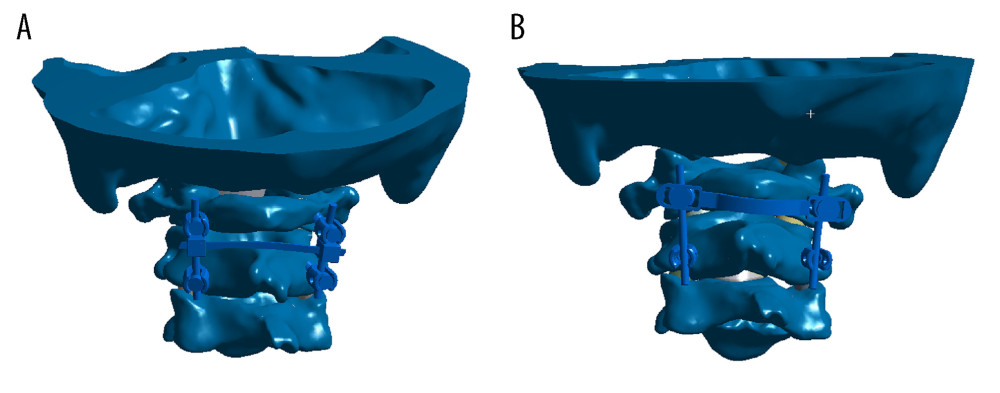 Two atlantoaxial fixation models: (A) horizontal rod-rod crosslink (hR-R CL) fixation model; (B) alternative horizontal screw-screw crosslink (hS-S CL) fixation model.