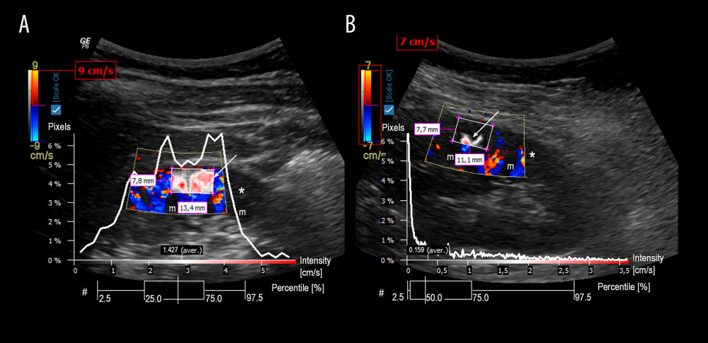 Graphical presentation of the ultrasound examinations and analyses of renal cortical perfusion in the 2 patients with different free thyroxine concentrations. Graphics present the perfusion relief (white arrow) and the perfusion intensity (white curve) assessment in the renal cortex. A diagram Pixels/Intensity is a quantitative evaluation of RCP showing how many pixels within the investigated region of interest are related to the intensity of the respective value. A box-plot diagram (#) expresses the distribution of pixel perfusion intensity, in percentiles (whisker: 2.5% and 97.5%; box 25% and 75%; vertical line in the box 50% – median). A – examination of a patient with FT4 25.93 pmol/L and RCP 1.427 cm/s; B – examination of a patient with FT4 14.77 pmol/L and RCP 0.159 cm/s; * – renal cortex; m – renal medulla.