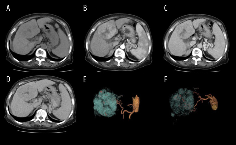 Scans from a 75-year-old woman (body mass index, 28.1 kg/m2) with hepatitis B cirrhosis. Liver CT was performed at 120 kV (size-specific dose estimate, 16.04 mGy) and contrast medium 550 mg I/kg. (A) Non-enhanced, (B) late arterial, (C) portal venous, and (D) delay phase images; and (E, F) 3D volume-rendering of reconstruction images, with arteries in yellow and tumor in blue. A hypervascular tumor can be seen in the liver, with hypodensity (A), hypervascularity (B), and washout (C, D) relative to the liver parenchyma. Three-dimensional volume-rendering reconstruction images show the relationship between the arteries and the tumor (E, F). The tumor diagnosis of hepatocellular carcinoma was confirmed by pathology.