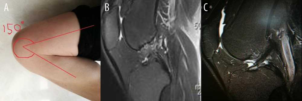 (A) The sketch of maximum flexion of knee joint with maximum flexibility of 150°. (B) Image from a 37-year-old man, 13 months after injury. Only routine position magnetic resonance imaging (MRI) scans were provided. The display angle of anterior cruciate ligament attachment points was poor. Sagittal and coronal scanning images both had effusion disturbing the diagnosis. (C) Image from a 45-year-old man. Only routine position MRI scans were provided. The joint effusion or hemorrhage near the ligament tear site interfered with the diagnosis.