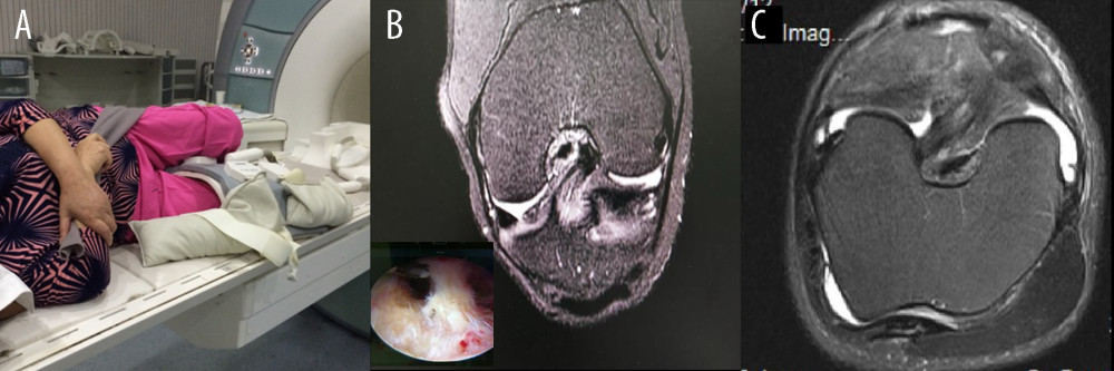 (A) Maximum knee flexion in lateral decubitus position magnetic resonance imaging examination of knee joint: the knee joint of the affected side in side position with maximum flexion with the coil tightly wrapped around the knee joint. (B) After additional special position scanning, the tear site showed high signal, which was diagnosed as a chronic partial tear of anterior cruciate ligament. It was confirmed by arthroscopy. (C) After additional special position scanning, the joint effusion or hemorrhage was squeezed away from the ligament tear site.