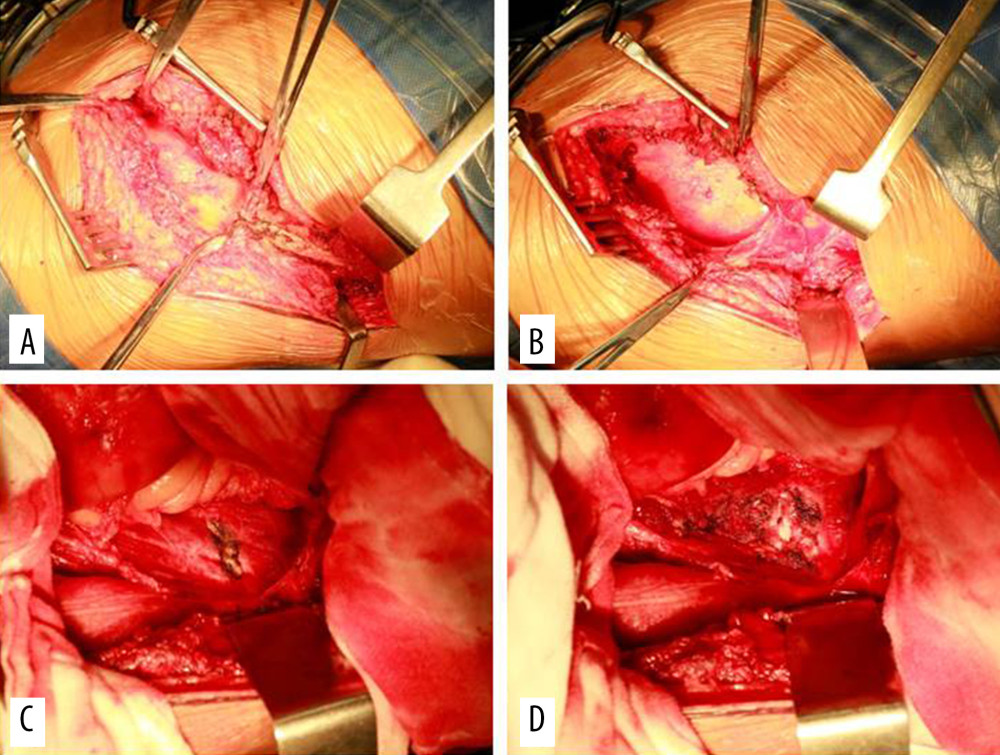 The subdiaphragmatic extraperitoneal approach: (A) expose and remove the 12th rib; (B) cut the abdominal wall muscles at the end of the ribbed bed and enter the extraperitoneum; (C) expose the psoas and square muscles; (D) cut the diaphragm and psoas attachment points lateral-anterior of the affected vertebra, push the crura of diaphragm upward, push the psoas away from the vertebra, and expose the L1–2 vertebral body and disc.