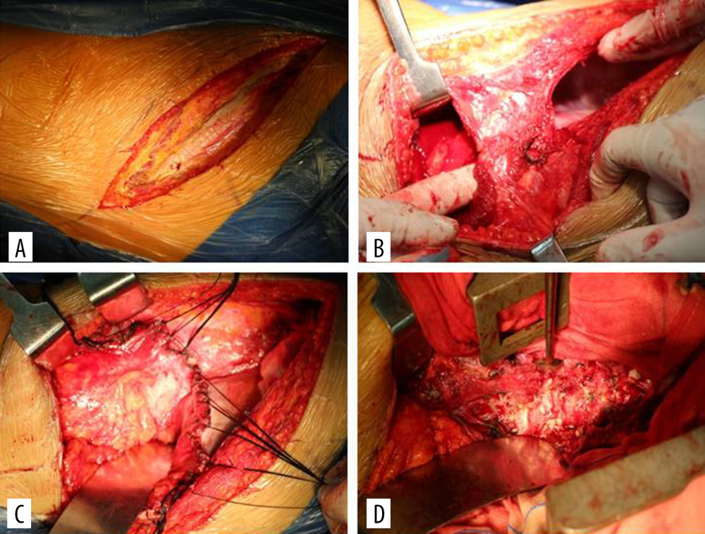 The thoracoabdominal approach: (A) expose and cut the 11th rib; (B) cut the rib bed and abdominal wall muscles, enter the extraperitoneal cavity and the thoracic cavity, expose the diaphragm; (C) cut the diaphragm muscle 2 cm away from the 11th rib attachment point; (D) expose L1–2 vertebral body and disc.