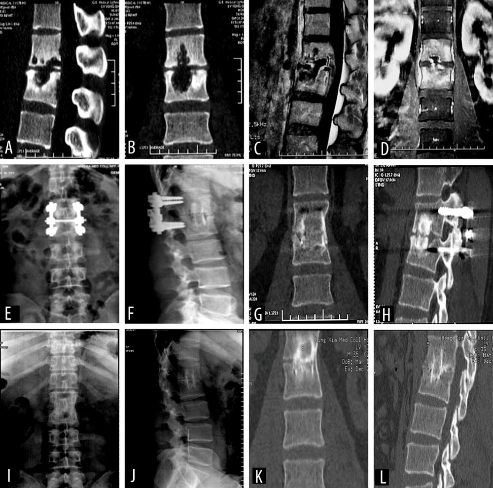 A 30-year-old male patient diagnosed with L1–2 vertebral tuberculosis was treated with posterior affected-vertebrae fixation, anterior subdiaphragmatic extraperitoneal approach for thorough lesion removal, and autologous iliac bone graft fusion. (A, B) Preoperative computed tomography (CT) showed obvious bone destruction. (C, D) Enhanced magnetic resonance imaging before surgery showed vertebral signal changes, vertebral bone destruction, and paravertebral abscess. (E–H) X-ray and CT at 6 months after surgery showed pedicle screw fixation and good bone graft fusion. (I–L) X-ray and CT 5 years after surgery showed that the pedicle screw had been completely removed, the lesion had completely cured, and the bone graft had completely fused.