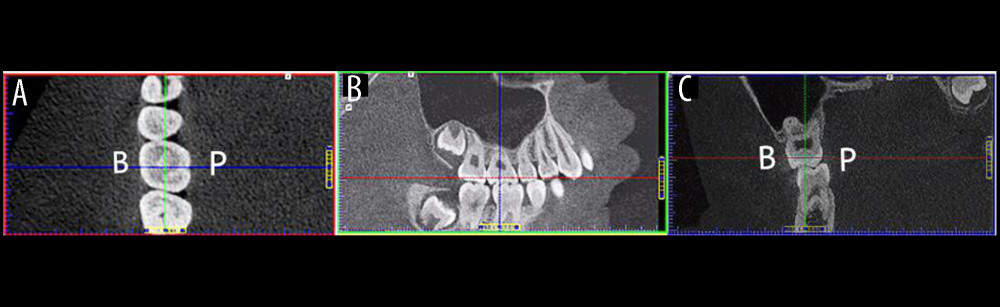 Cone-beam computed tomography images identifying the baseline plane of a right maxillary first molar for subsequent measurements of anatomical landmarks. (A) The axial plane view shows that the blue line has been adjusted to be parallel to the mesial and distal crown margin tangential line and bisects the baseline plane. Similarly, the green line has been adjusted to be parallel to the buccal and lingual crown margin tangential line and bisects the baseline plane. (B) The sagittal plane view shows that the tooth has no mesial-distal tilt. This was achieved by adjusting the longitudinal axis of the target tooth parallel to the blue line. (C) The coronal plane view shows that the tooth has no buccal-lingual tilt. This was also achieved by adjusting the longitudinal axis of the target tooth parallel to the green line.