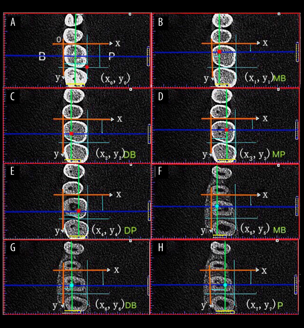Each pulp horn and root canal orifice was identified according to the first appearance of their low-density shadow and was designated by the x, y coordinates in the X and Y axes system. (A) Buccal-lingual distance; Mesial-distal distance. (B–E) Pulp horns (red dots): the intersection of the coronal plane (blue line) and the sagittal plane (green line) (MB, DB, MP, DB). (F–H) Root canal orifices (blue dots): the intersection of the coronal plane (blue line) and the sagittal plane (green line) (MB, DB, P). MB – mesiobuccal; DB – distobuccal; MP – mesiopalatal; DP – distopalatal; P – palatal.