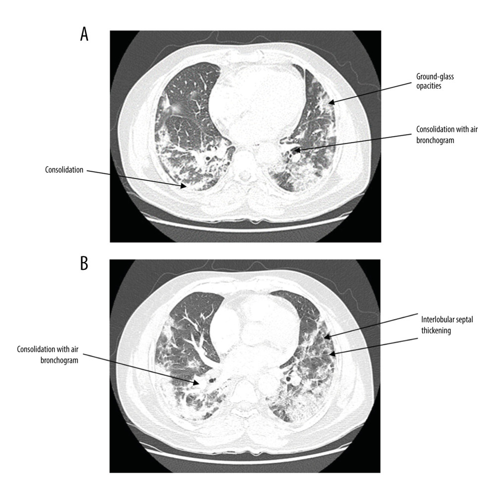 (A) CT scan of patient with laboratory-confirmed COVID-19 shows bilateral scattered areas of peripheral consolidation and ground-glass opacities (CT scan: GE discovery CT750 hd). (B) CT scan of patient with laboratory-confirmed COVID-19 shows minimal interlobular septal thickening and right upper perihilar consolidation with air bronchogram (CT scan: GE discovery CT750 hd).