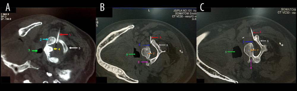 The radiofrequency ablation (RFA) puncture path for treatment of the cervical dorsal root ganglion. (A) An RFA puncture path through the C2 dorsal root node. (B) An RFA puncture path through the C3 dorsal root node. (C) An RFA puncture path through the C4 dorsal root node. 1: radiofrequency puncture needle, 2: odontoid of the axis, 3: foramen intervertebrale, 4: lamina, 5: cavum pharyngis, 6: vertebral artery, 7: centrum.