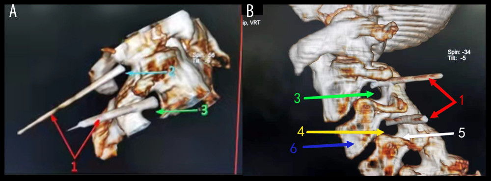 A 3-dimensional reconstruction of puncture position on the cervical dorsal root ganglion during radiofrequency ablation. (A) The puncture needle was located in the intervertebral foramen of C2 and C3 spinal canal, seen here from the side. (B) The puncture needle was located in the intervertebral foramen of C3 and C4 spinal canal, seen here from the lower side. 1: radiofrequency puncture needle, 2: C2 foramen intervertebrale, 3: C3 foramen intervertebrale, 4: C4 foramen intervertebrale, 5: transverse foramen, 6: centrum.
