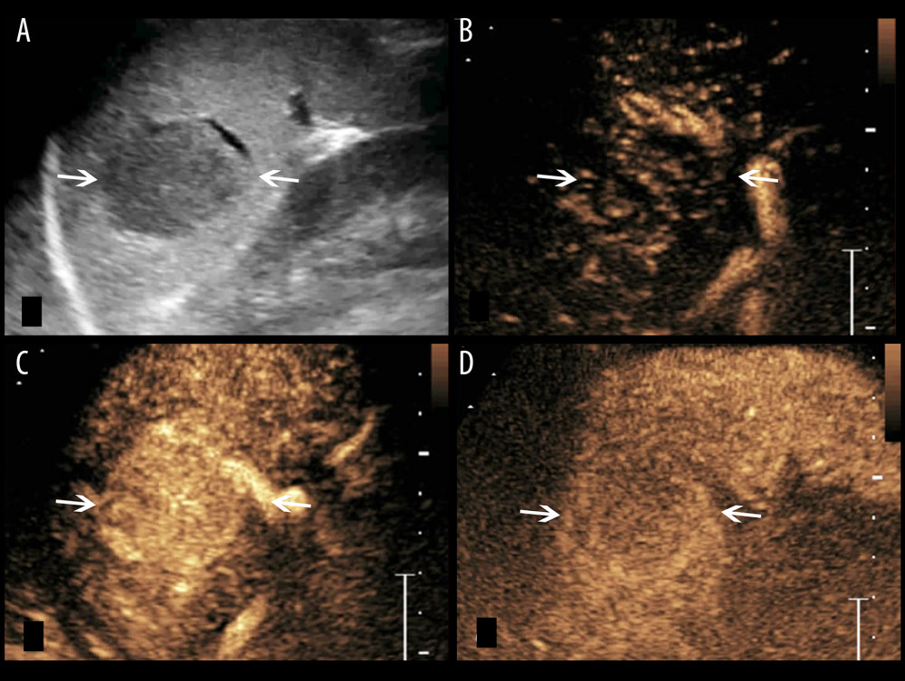 A splenic TB lesion with hyper-enhancement. (A) Conventional US demonstrates a hypoechoic lesion with a relatively well-defined border (arrows); (B–D), CEUS demonstrates that the lesion become diffuse enhancement at 8 s after injection of SonoVue (B), followed by homogeneous enhancement at 10 s after injection (C, arrows) and hypo-enhancement in the late parenchymal phase (D, arrows).