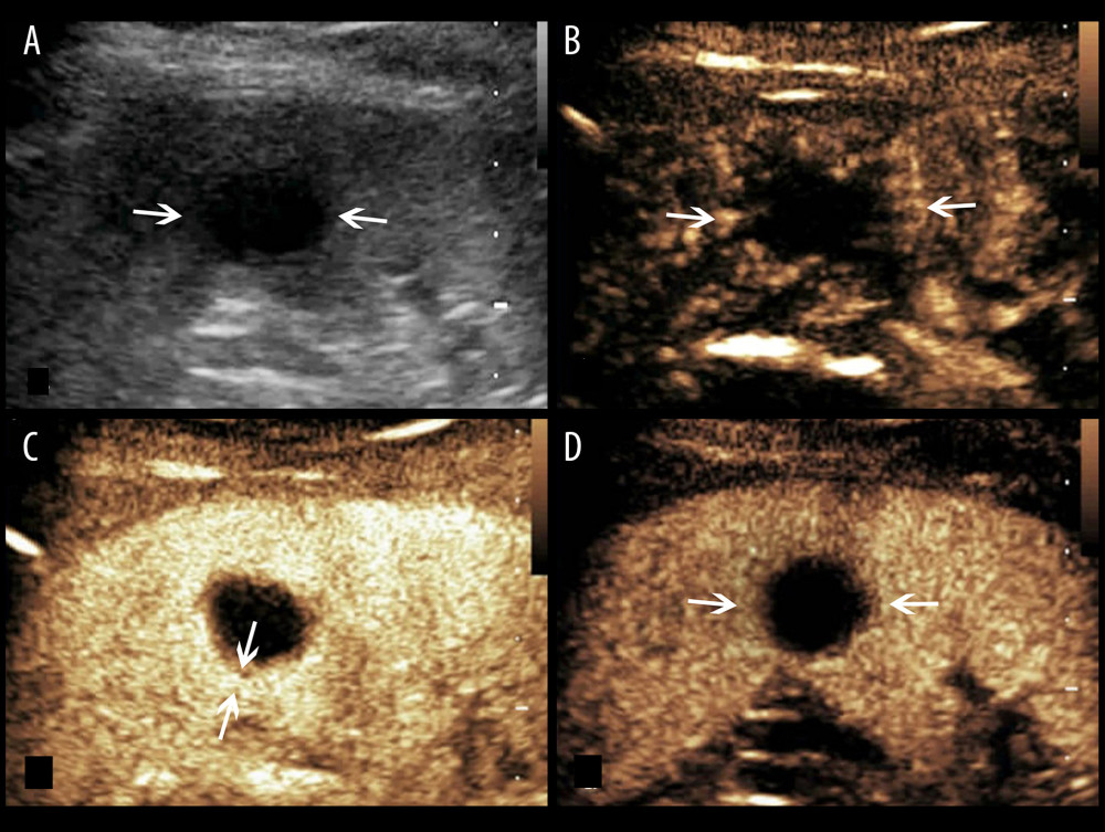 A splenic TB lesion with rim-like enhancement. (A) Conventional US demonstrates a hypoechoic lesion with relatively well-defined boundary (arrows); (B–D), CEUS demonstrates that the lesion began to enhance from the margin at 12 s after injection of the SonoVue (B, arrows) and presents rim-like enhancement at 25 s (C, arrows), followed by hypo-enhancement compared with the peripheral splenic parenchyma in the late parenchymal phase (D, arrows).