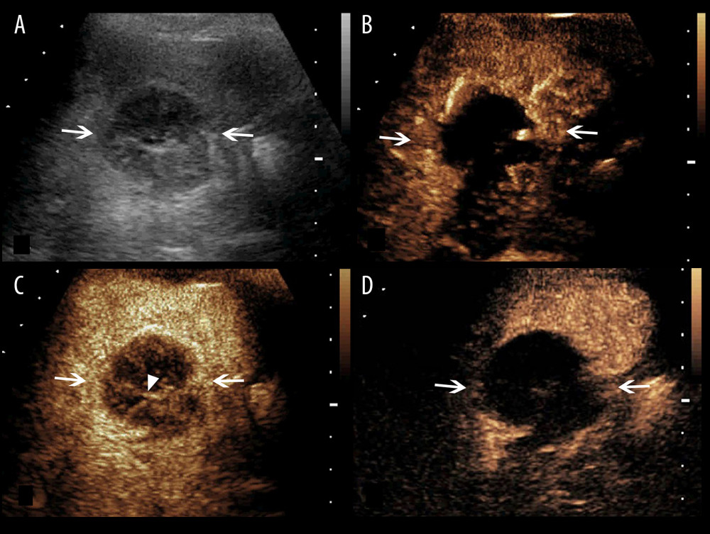A splenic TB lesion with septation-like enhancement. (A) Conventional US demonstrates a hypoechoic lesion with a well-defined border and heterogeneous(arrows); (B–D) CEUS demonstrates that the lesion begins to enhance from the margin at 13 s after injection of SonoVue (B, arrows) to the internal in a septation-like manner at 30 s (C, head arrows). The internal septation-like enhancement is washed out and the marginal tissues become iso-enhanced compared with the peripheral splenic parenchyma in the late parenchymal phase (D, arrows).