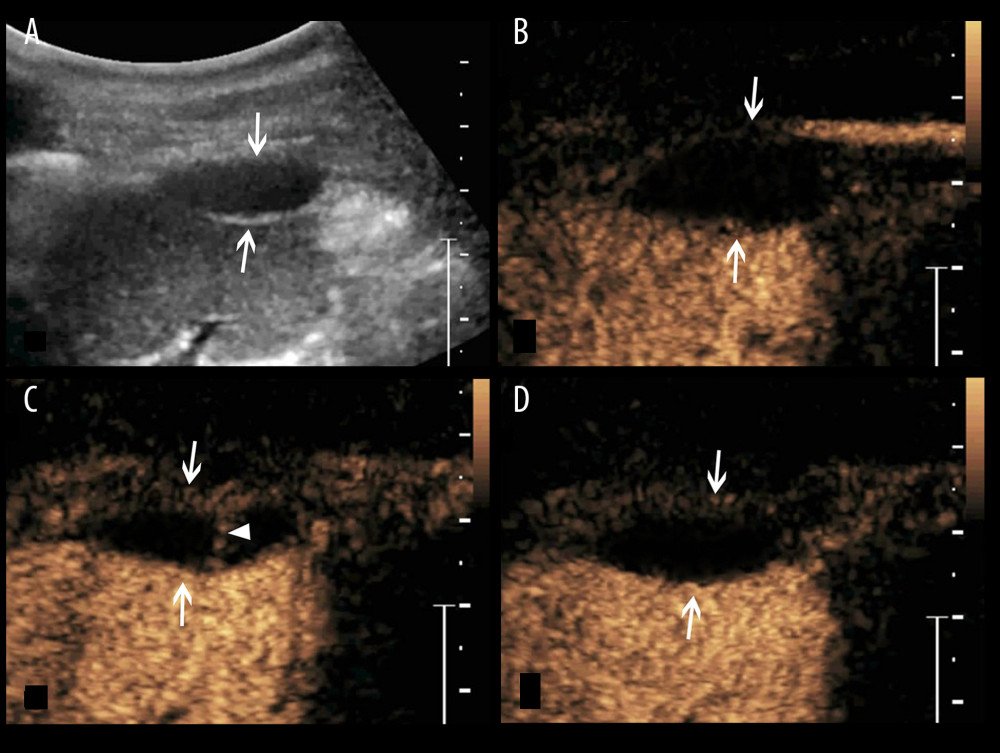 A splenic TB lesion with septation-like enhancement. (A) Conventional US demonstrates a hypoehoic lesion in the splenic envelope with a well-defined border (arrows); (B–D) CEUS demonstrates that the lesion begins to enhance from the splenic envelope at 30 s after injection of SonoVue (B, arrow) toward the peritoneum. Its internal area is presented with septation-like enhancement at 32 s (C, head arrows), which is completely washed out in the late parenchymal phase. The marginal area is iso-enhanced compared with the peripheral splenic parenchyma (D, arrows).