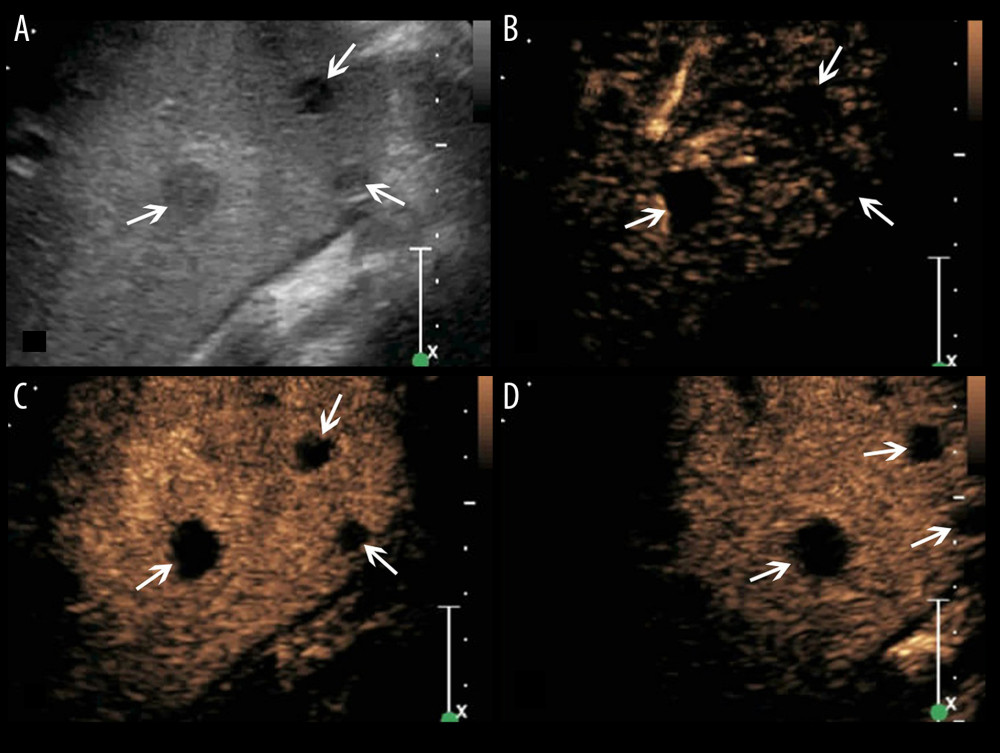 A splenic TB case with multiple non-enhanced splenic lesions. (A) Conventional US demonstrates 3 hypoechoic splenic lesions with relatively ill-defined borders (arrows); (B–D) CEUS demonstrates the 3 lesions show non-enhancement during all phases (arrows).